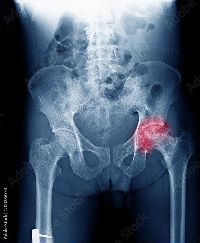 X-ray image of painful hip in man present Osteoarthritis left hip joint at red area mark