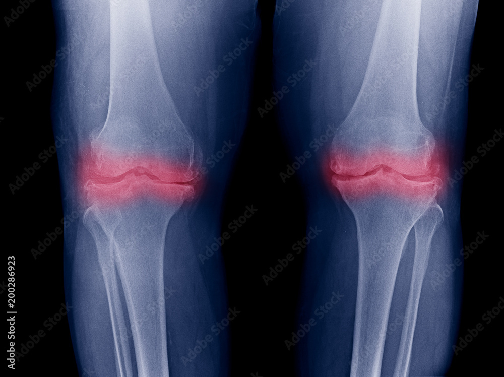 Osteoarthritis Knee ( OA Knee ). Film xray both knee ( front view