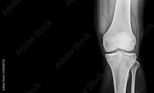 x-ray image of knee with left blank space to add other text