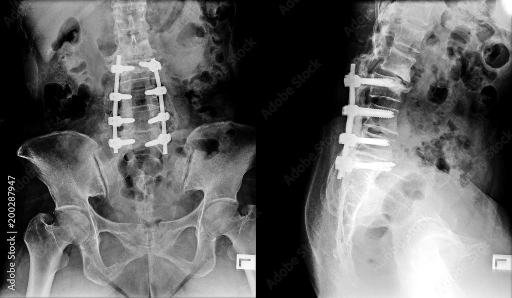 Xray image of lumbar spine postoperative treatment for degenerative