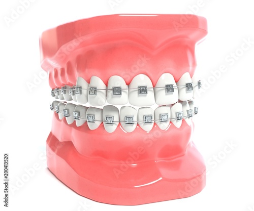 3d illustration of a mouth with braces