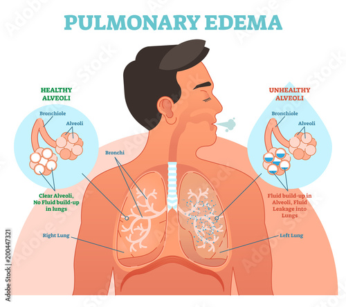 Pulmonary edema, lung problem vector illustration diagram