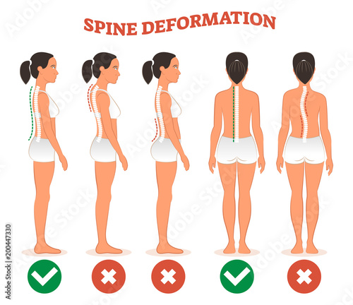 Spine deformation types and healthy spine comparison diagram poster.