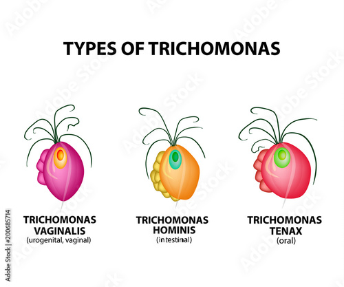 Types Trichomonads. Intestinal, oral, vaginal trichomonas structure. Trichomoniasis. Urogenital infection. Infographics. Vector illustration on isolated background. photo