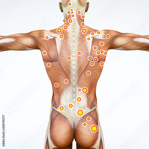 Vista di spalle di una persona, muscoli della schiena con i trigger points evidenziati. Anatomia e corpo umano