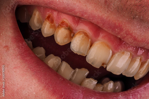 Dental medicine and healthcare - human patient open mouth showing caries teeth decay. Unhealthy denture, tartar on frontal teeth, plaque and gingivitis.