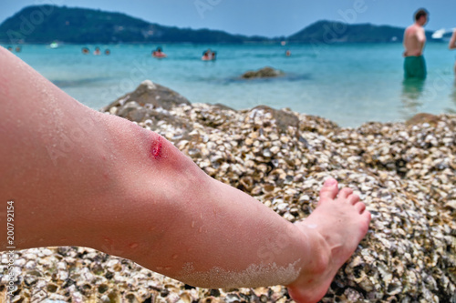 Fototapeta Naklejka Na Ścianę i Meble -  Bleeding on the knee boy. Child wounded his leg against coral reef on tropical beach. Concept of safety when swimming in the sea.