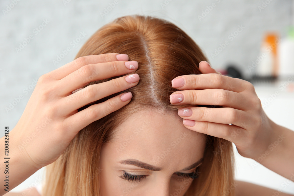 Fototapeta premium Young woman with hair loss problem, closeup