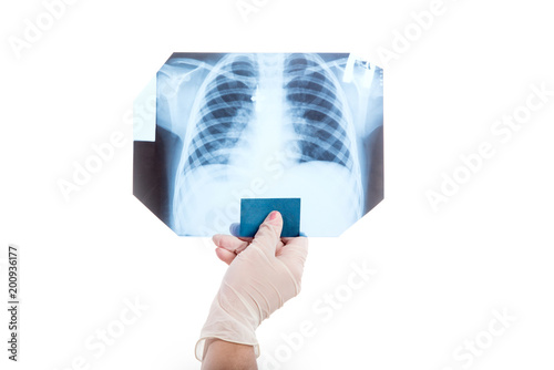 The doctor is studying an x-ray image of the human chest to identify pneumonia.