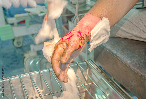 Dressing burned wound