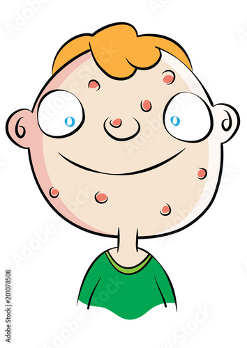 cute white boy with acne problem