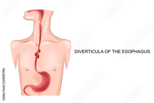 diverticula of the esophagus photo