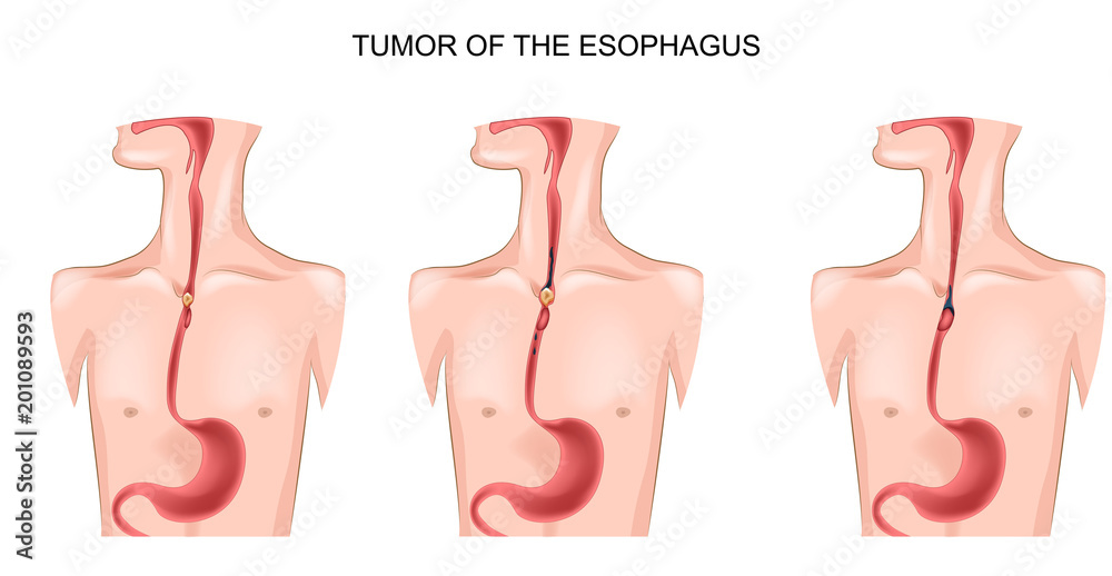 tumor of the esophagus