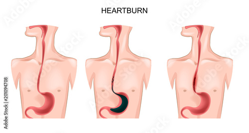 stomach, esophagus, heartburn photo