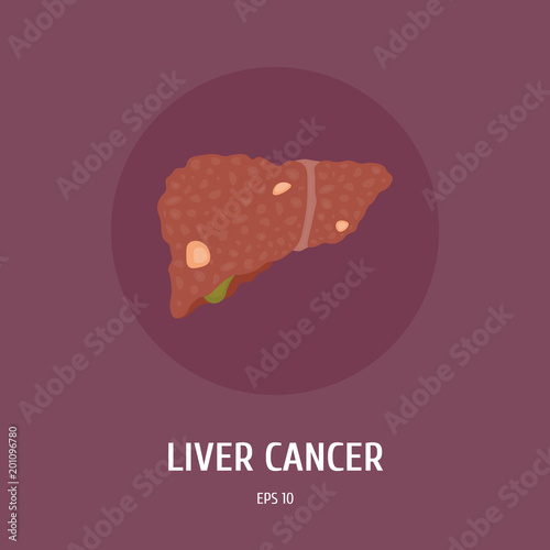 Liver cancer. Internal organs of man. Surgery. Vector Flat Illustration