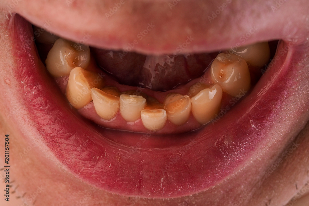 Malocclusion. Crowding of the teeth of the lower jaw. Close-up of a man mouth with crooked teeth.