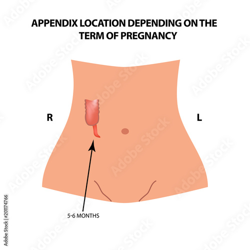 The location of the appendix depends on the term of pregnancy. 5-6 months. Infographics. Vector illustration on isolated background.