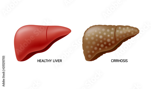 Comparison of healthy liver and cirrhosis. Liver Disease. Illustration info-graphic, isolated on white background.