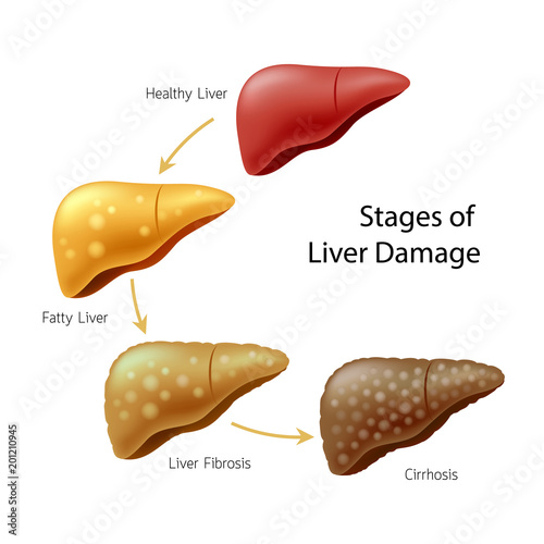 Stages of liver damage. Liver Disease. Healthy, fatty, fibrosis and Cirrhosis. Illustration info-graphic, isolated on white background.