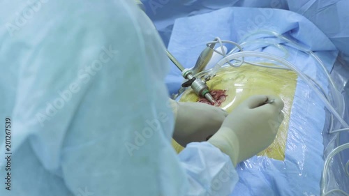 Close up hands of a surgeon making an incision with a scalpel on the abdomen of the patient