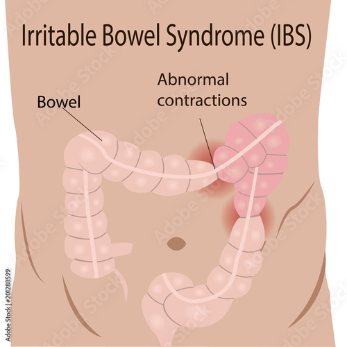 Irritable bowel syndrome (IBS) in a large intestine