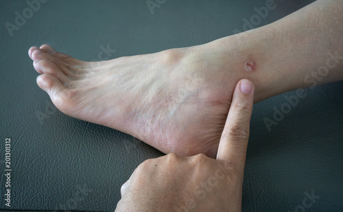 Finger pointing to the Ringworm, fungal infection of the skin