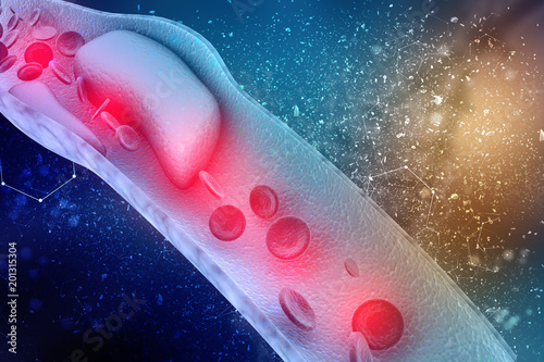 3d rendering blood cells with plaque buildup of cholesterol symbol of vascular illness