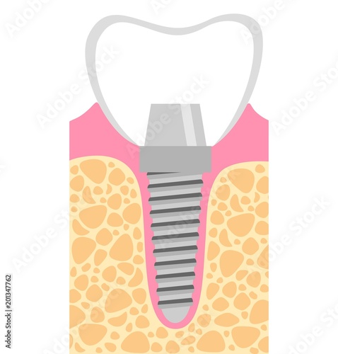 Dental implant Vector Illustration