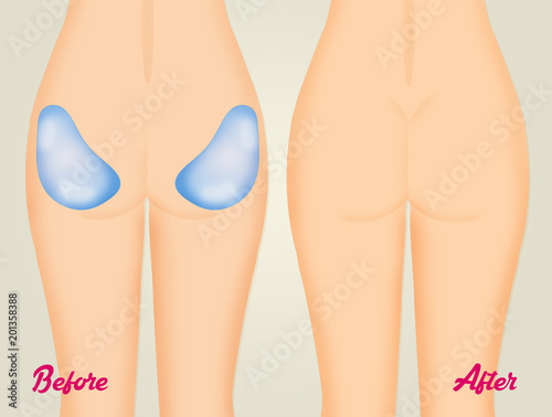 Obraz na płótnie illustration of buttocks implants