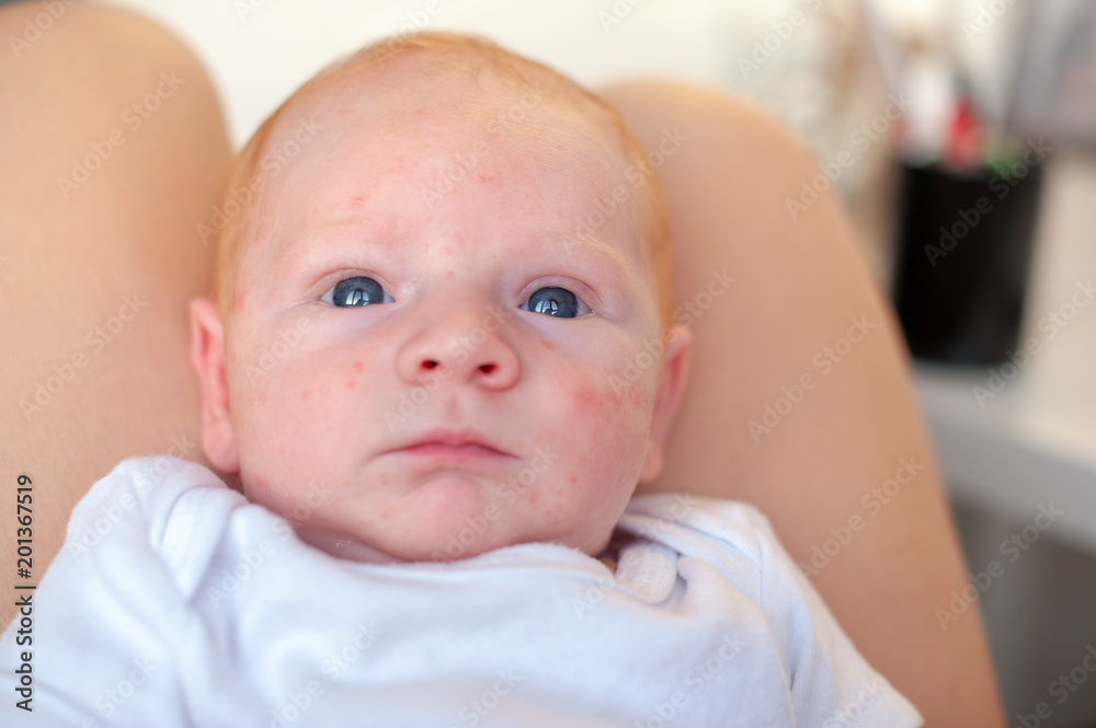Traces of an allergy on the face of a baby Traces of an allergy on the face of a baby