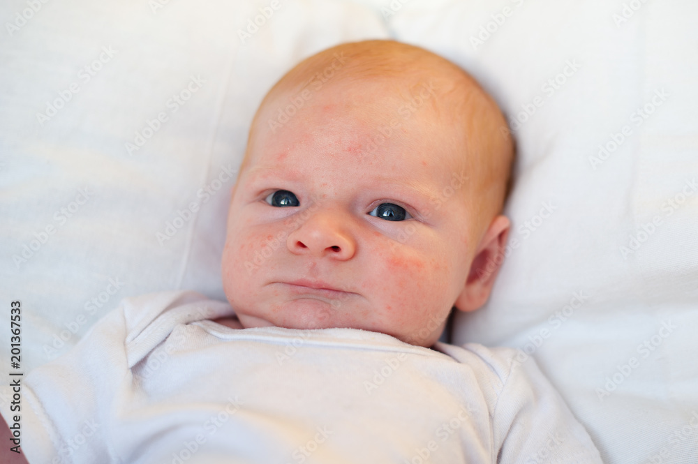 Infant acne, allergy, atopic dermatitis on the face of a baby Infant acne, allergy, atopic dermatitis on the face of a baby