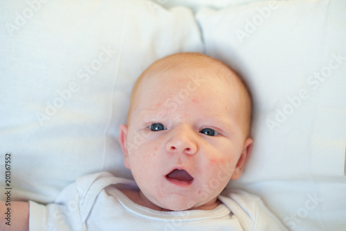 Infant acne, allergy, atopic dermatitis on the face of a baby