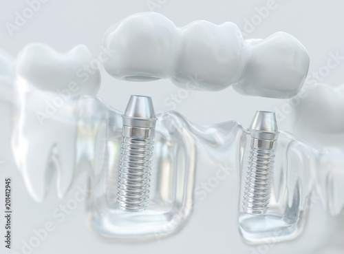 Implants with dental bridge - 3d rendering photo