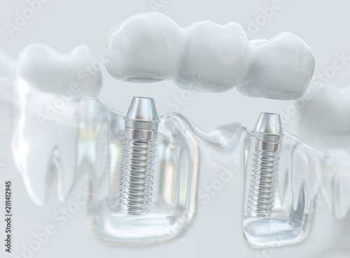 Implants with dental bridge - 3d rendering