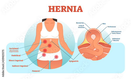 Hernia types vector illustration and cross section of muscle rupture and intestine. photo