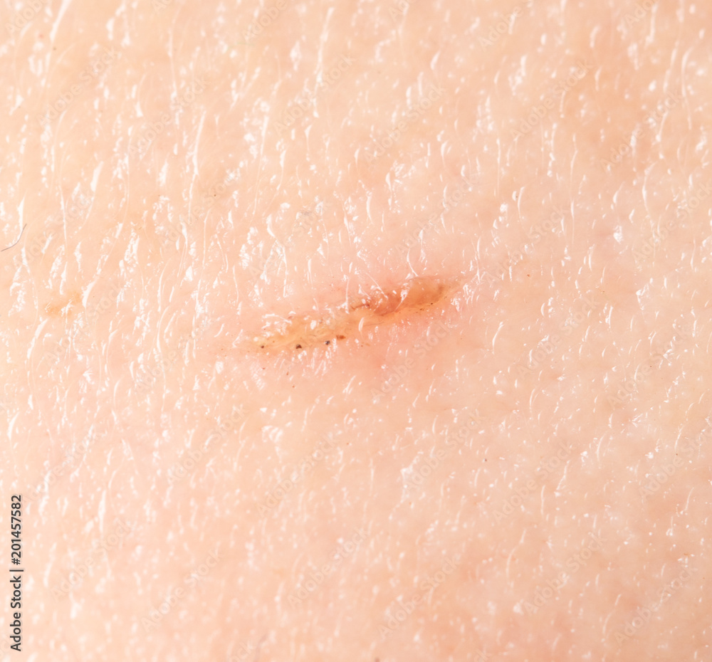 Fototapeta premium A wound on the human skin as a background