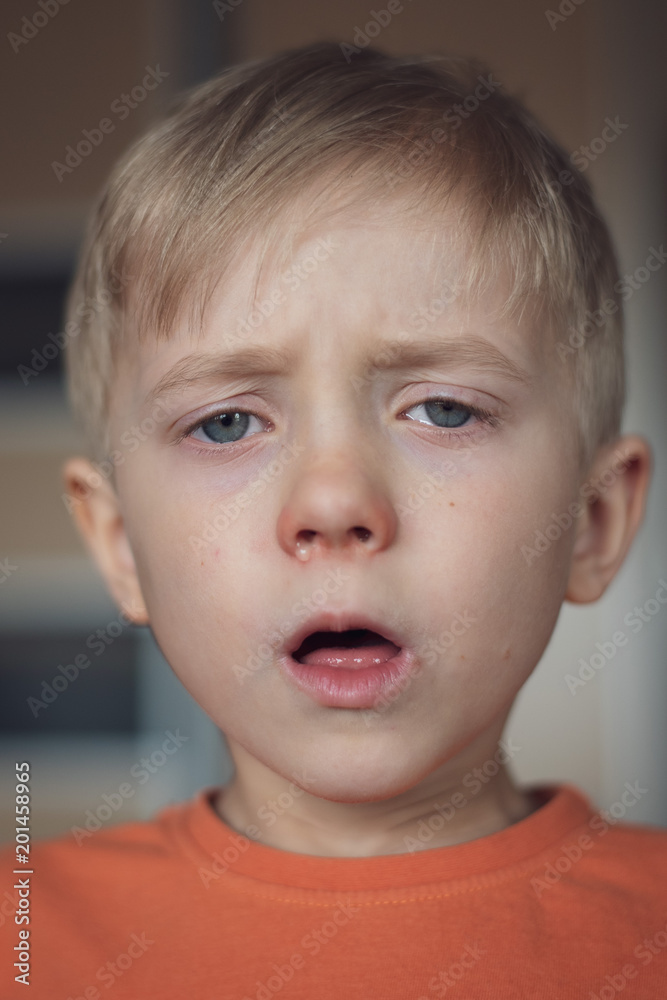 Five years old boy with allergy runny nose and glazed eyes. Five years old boy with allergy runny nose and glazed eyes.