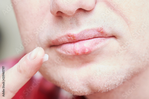 Canvastavla herpes simplex virus infection