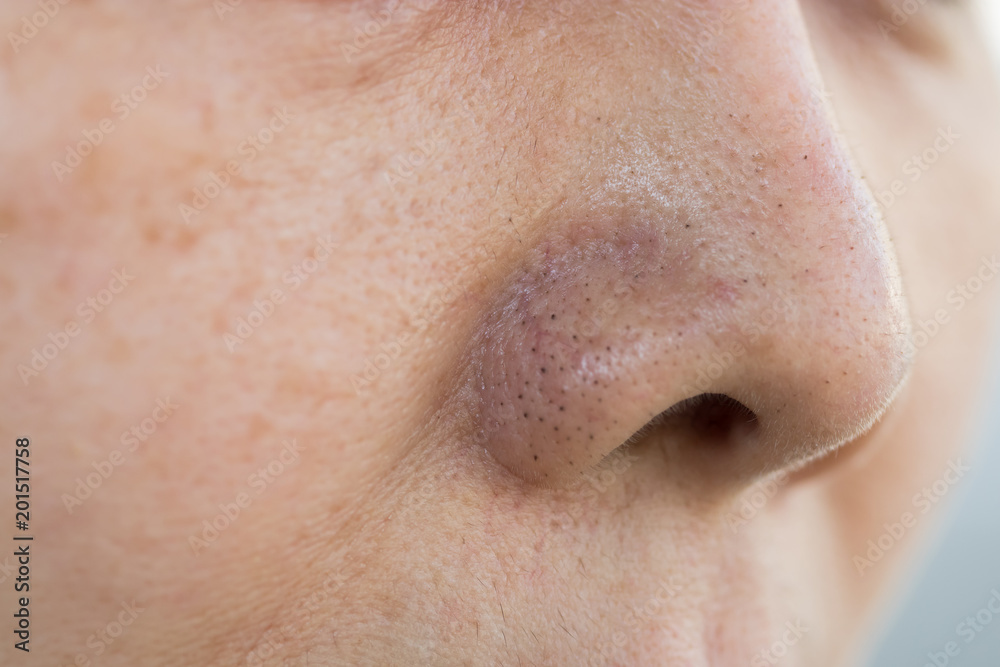Pimples on the face of Asian women Pimples on the face of Asian women