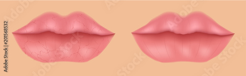 healthy and dry lip vector / mouth with no moisturizer / filler