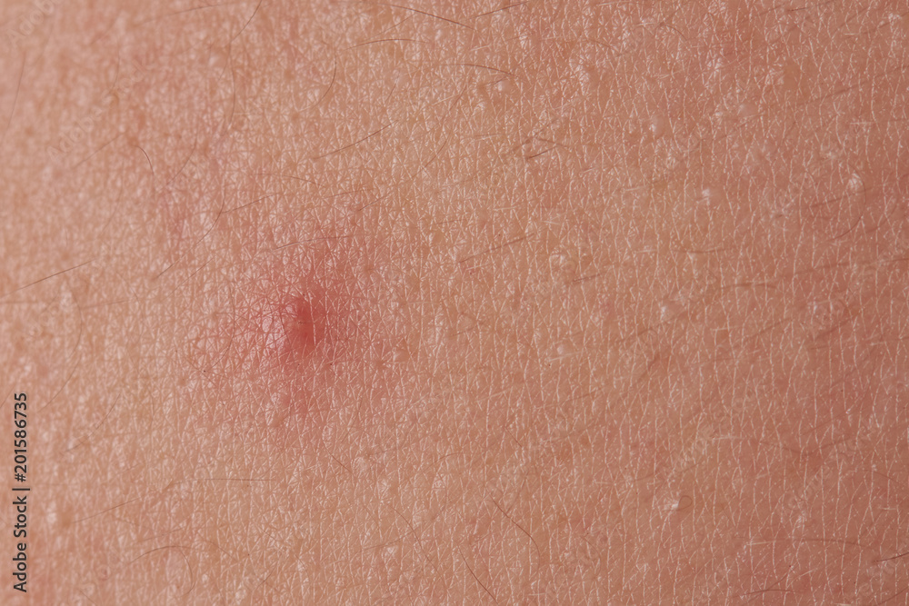 Red pimple on human skin