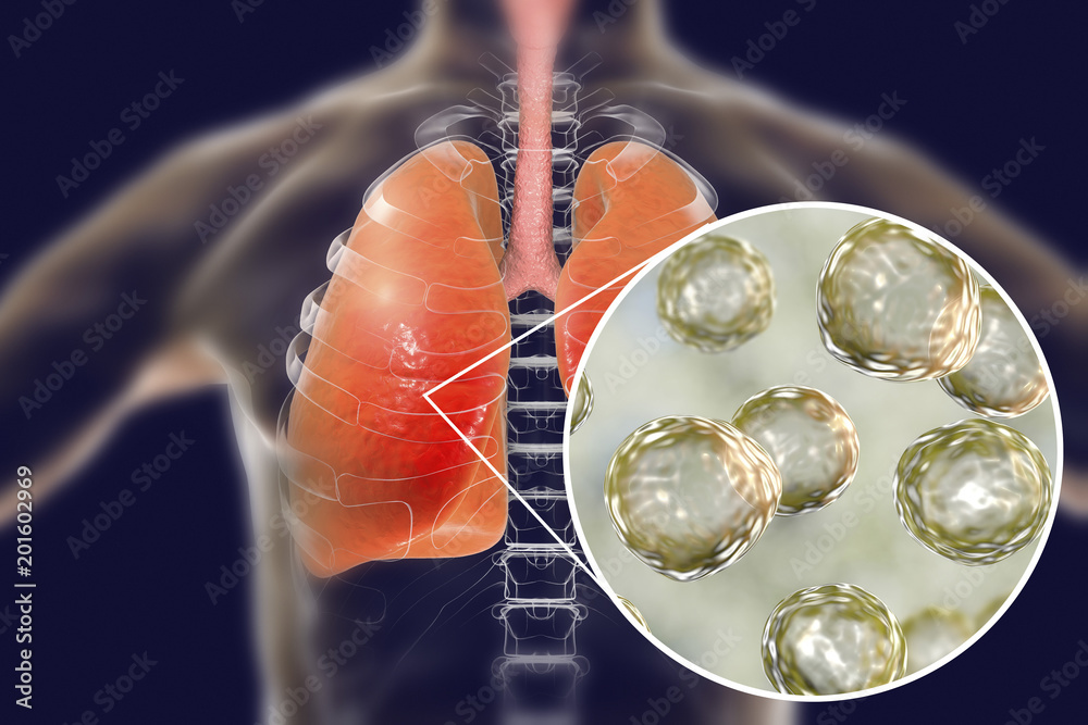 Blastomyces dermatitidis infection of lungs, conceptual image, 3D