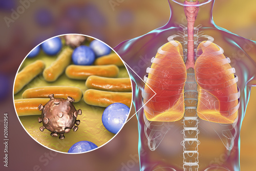 Pneumonia, medical concept, 3D illustration showing human lungs and close-up view of microbes in lungs photo