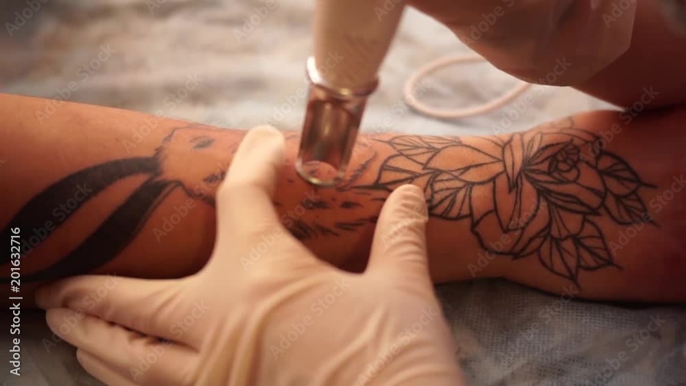 Tattoo removal laser. A young girl removes the tattoo with a laser.