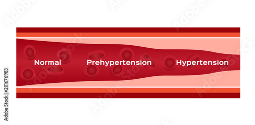 hypertension , high blood pressure vector / human anatomy