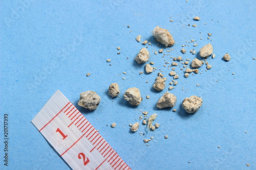 very small kidney stones with ruler at blue background