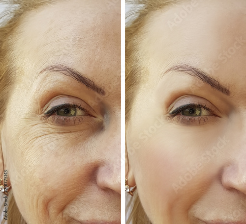 Obraz na plátně woman face wrinkles before and after procedures