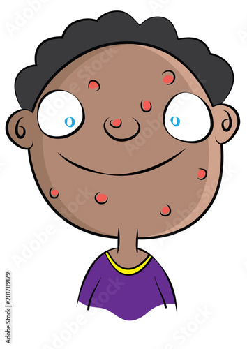 cute black boy with acne problem