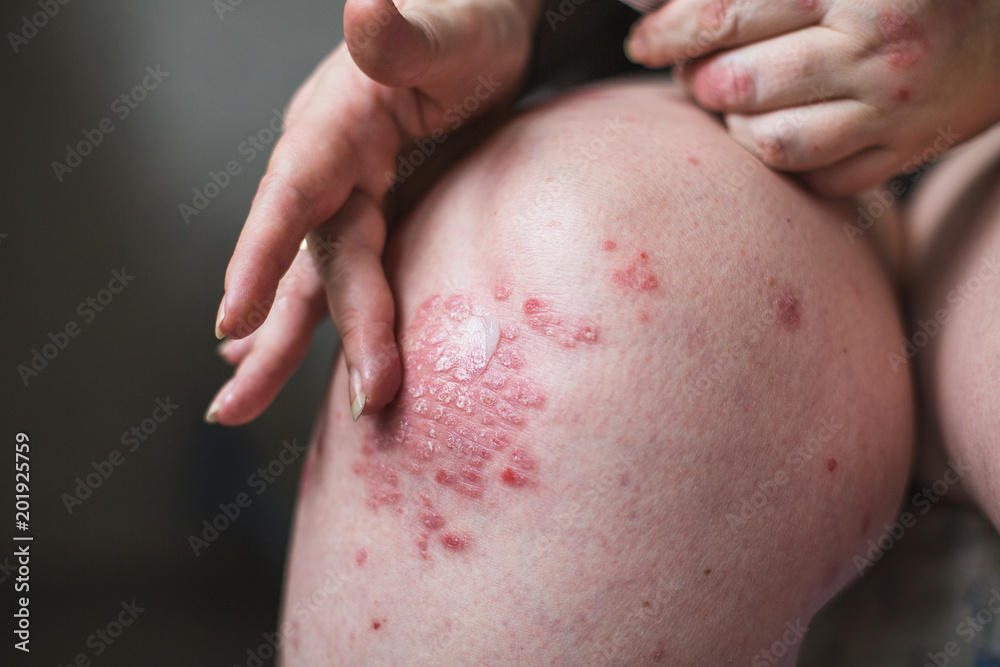 applying an emollient to dry flaky skin as in the treatment of psoriasis, eczema and other dry skin conditions. Health concept applying an emollient to dry flaky skin as in the treatment of psoriasis, eczema and other dry skin conditions. Health concept