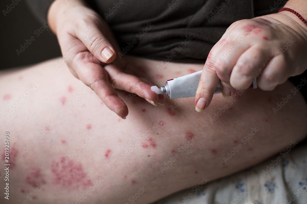 applying an emollient to dry flaky skin as in the treatment of psoriasis, eczema and other dry skin conditions. Health concept applying an emollient to dry flaky skin as in the treatment of psoriasis, eczema and other dry skin conditions. Health concept